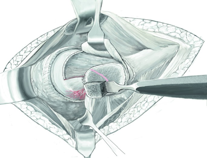 Palpation des kleinen Trochanters