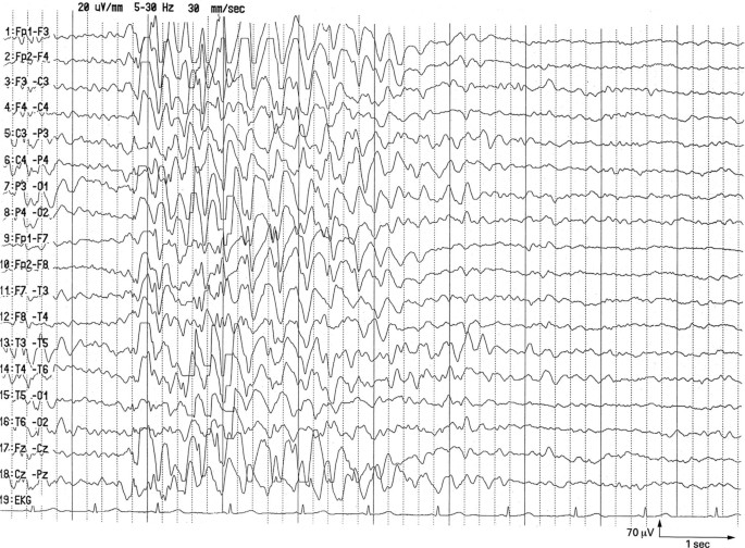 EEG unter Hyperventilation und Fotostimulation | SpringerLink