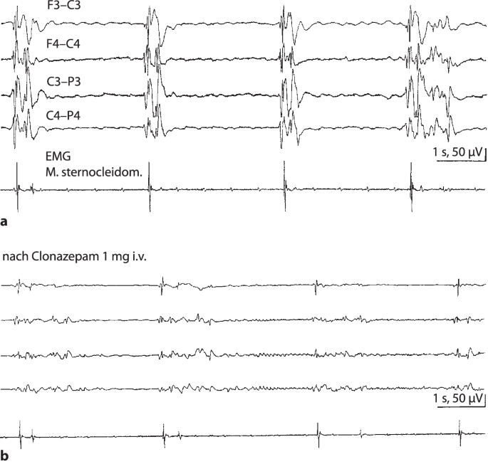 EEG bei diffusen Erkrankungen des Gehirns. Hypoxische und andere  Enzephalopathien. Nicht-konvulsiver Status epilepticus und Delir |  SpringerLink
