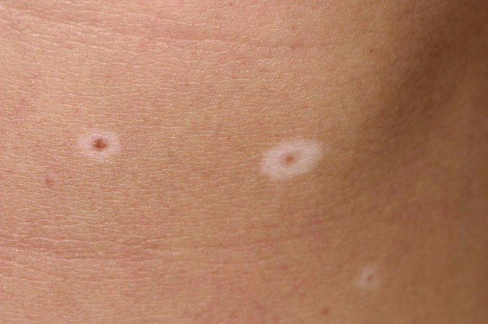 Melanotic Spots and Melanocytic Nevi | Springer Nature Link Melanotic Spots and Melanocytic Nevi | Springer Nature Link