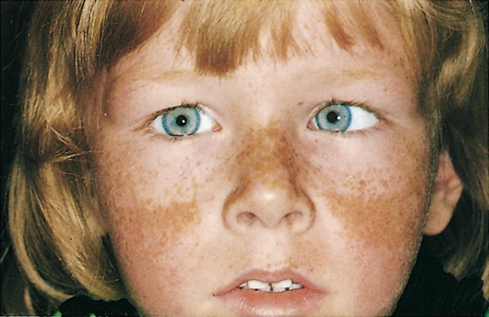 best time to take melanotan 2 Melanotan 2 Dosage: By Skin Type