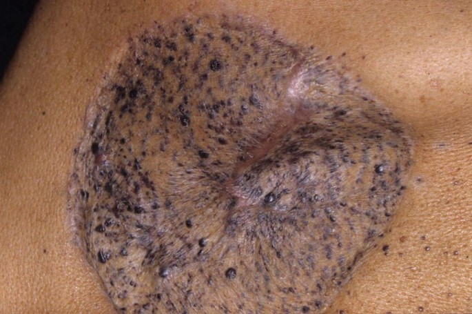 Nastro Nero Realistico - Simbolo Del Melanoma E Della Consapevolezza Del  Cancro Della Pelle Mese Illustrazione Vettoriale - Illustrazione di  campagna, speranza: 162697390