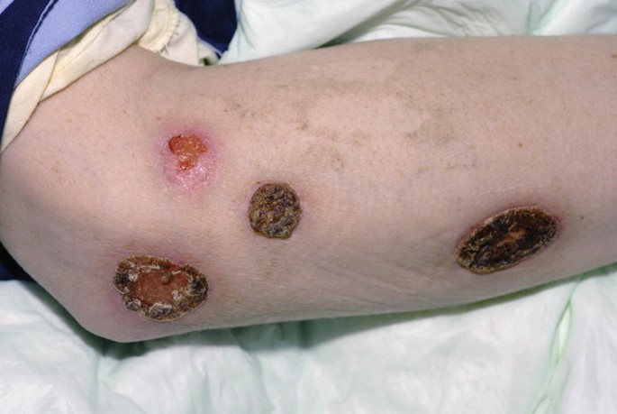 Syphilis-Causes-Symptoms-Diagnosis-Treatment-Homeopathic-Allopathic-Dr-Qaisar-Ahmed-Al Haytham-Clinic-Risalpur-KPK-Pakistan