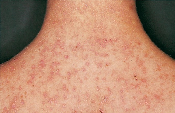 Is This a Breast Rash Caused by South American Larvae?