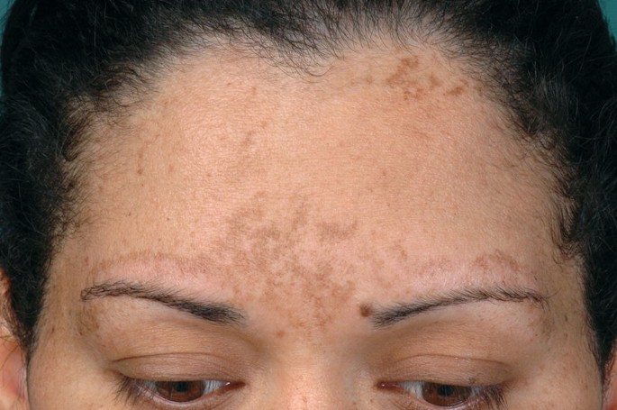melanotan hyperpigmentation Melanotan 2 Powder CAS 121062-08-6 Suppliers, Manufacturers, Factory -  Wholesale Price