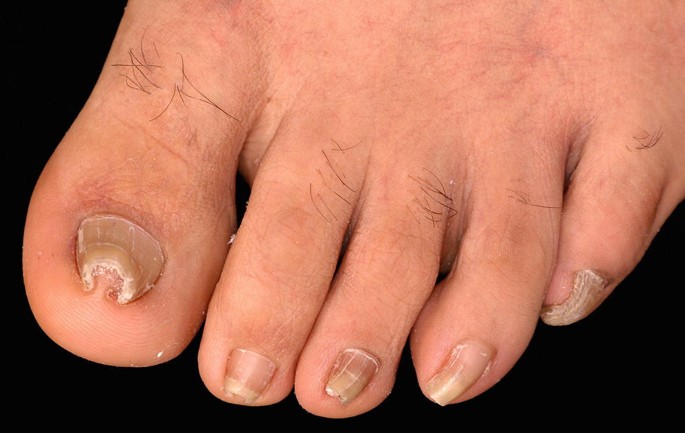 A Zigzag Flap for Correcting a Nail Deformity Caused by Subungual  Schwannoma in: Journal of the American Podiatric Medical Association Volume  111 Issue 4 (2021)