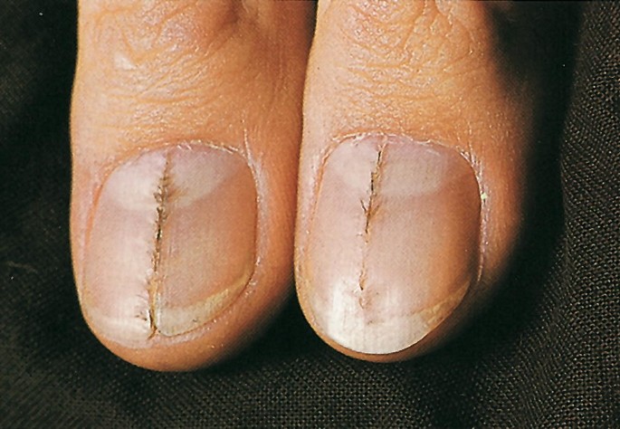 I was born with one really, really small stub of a toenail. : r/pics