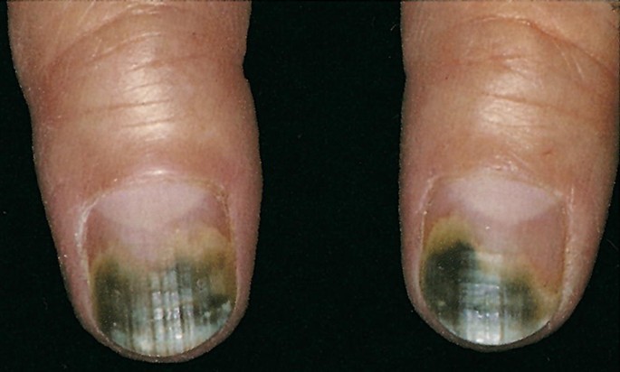 Chloronychia caused by Pseudomonas oryzihabitans infection
