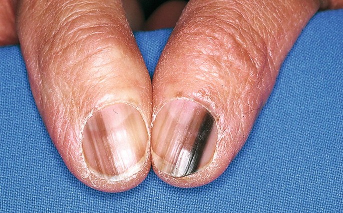 Diseases of Nails | Springer Nature Link