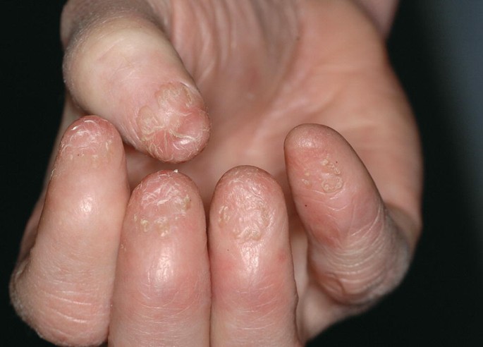 Painful nails: A practical approach to the diagnosis and management of  painful nail conditions - Olvera‐Rodríguez - 2021 - International Journal  of Dermatology - Wiley Online Library
