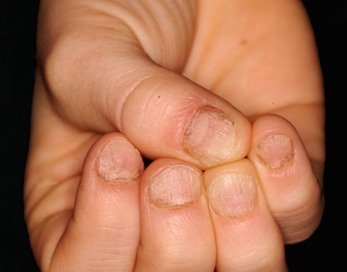 Pimple on the finger: Causes and treatment