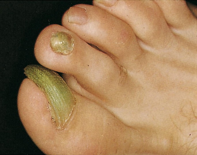 PPT - The most commonly reported nail conditions, seen by podiatrists, are:  Onychocryptosis, 26% PowerPoint Presentation - ID:6346379