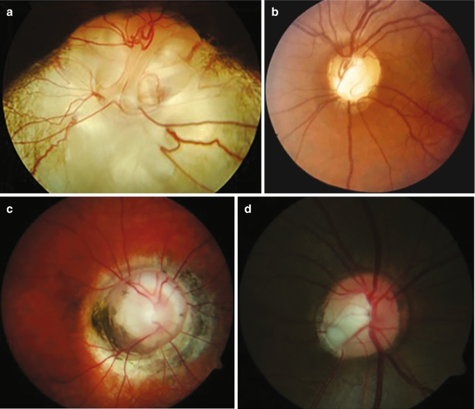 Differenzialdiagnose der Opticusatrophie mit vergrößerter  Papillenexkavation | SpringerLink