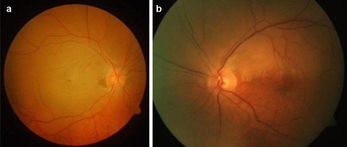 Der retinale Arterienverschluss | SpringerLink