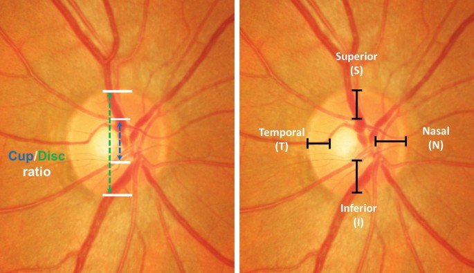 Glaukom: Sehnervenbeurteilung  Untersuchung, Foto, Kohrenztomografie |  Springer Nature Link