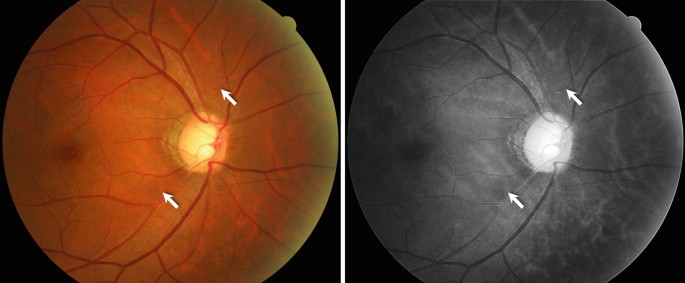Glaukom: Sehnervenbeurteilung  Untersuchung, Foto, Kohrenztomografie |  Springer Nature Link