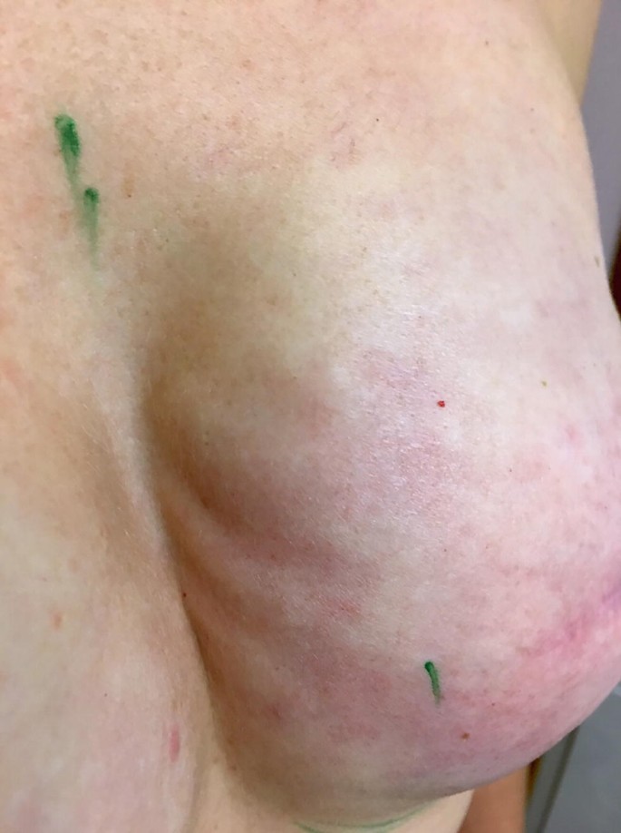 Rash on boobs after breast augmentation. Should I be concerned? (Photo)