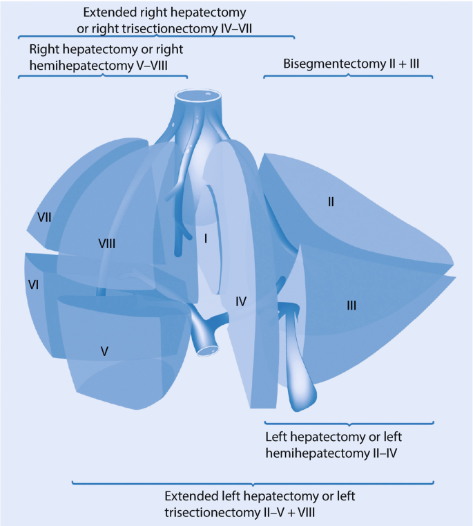 A 3-D illustration of the subdivision of the liver and captions. There are 8 subdivisions labelled extended right hepatectomy, right hepatectomy, bi-segmentectomy, left hepatectomy, and extended left hepatectomy.