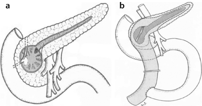 2 illustrations of the pancreas represent a surgical procedure with transverse laparotomy of the upper abdomen and dissection of the gastrocolic ligament.