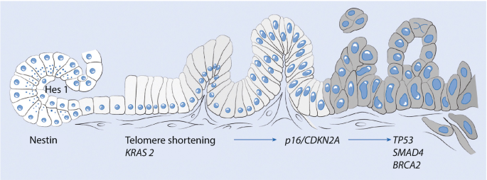 An illustration of adenoma-carcinoma sequence in pancreatic cancer. Markings read H E S 1, nestin, telomere shortening followed by P 16 slash C D K N 2 A followed by T P 53 S M A D 4 B R C A 2.