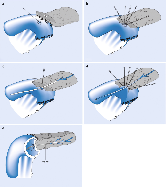 A 5-part illustration of pancreaticojejunostomy. Surgical procedures illustrate an end-to-side anastomosis with duct-to-mucosa anastomosis. The posterior wall is sutured, tie knotting, punctual opening, and exterior anterior wall suture is observed.