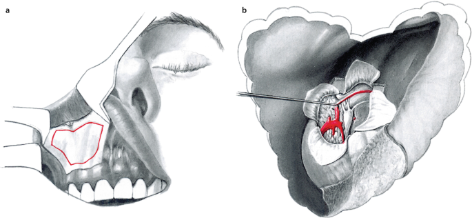 Tumor Operations of the Upper Oral Cavity, Maxilla, Midface and Anterior  Skull Base | SpringerLink