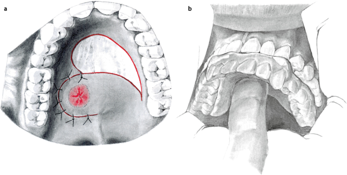 Marginal Mandibular Nerve Weakness (Ramus Mandibularis) - Level I Neck  Dissection (extended) recurrent pleomorphic adenoma - Clinical case example