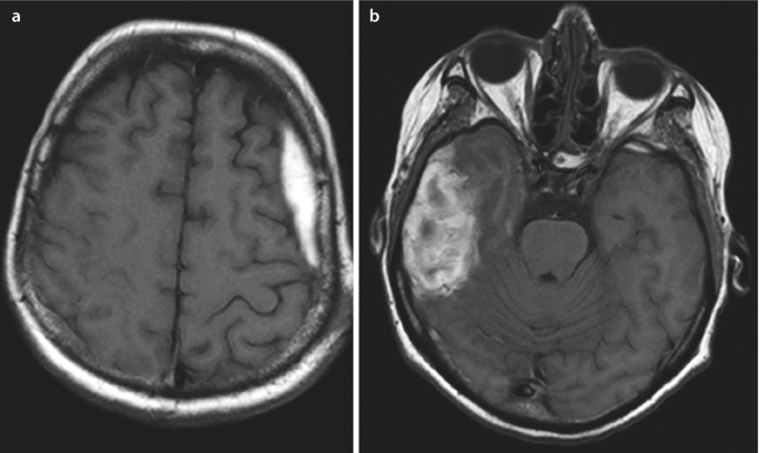 Schädel Hirn Trauma 2 Grades Spätfolgen link.springer.com