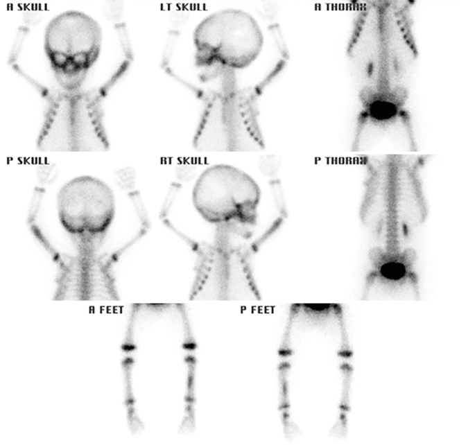 A set of X-rays of a child with swelling in the left arm. They are for the anterior skull, left skull, anterior thorax, posterior skull, right skull, posterior thorax, anterior and posterior feet.