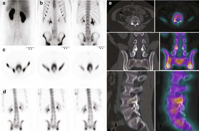 A set of bone scintigraphy. A. depicts a normal blood pool in the spine. B depicts the tracer uptake. C and D. depict 3 sets each for spinal trace uptake in the L 4 vertebra. E. depicts 6 C T scans of the spine with sclerosis detection on the vertebra.