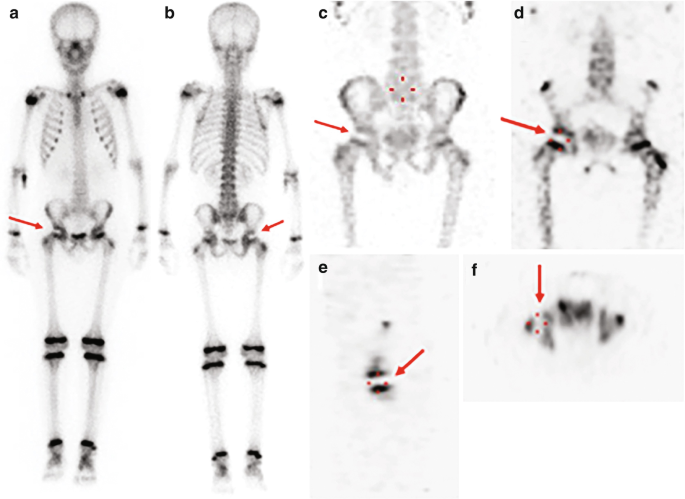 A and B are whole-body scintigraphy with right femoral heads marked. C to F are S P E C T of the femoral head with an M I P and photogenic areas marked by arrows.