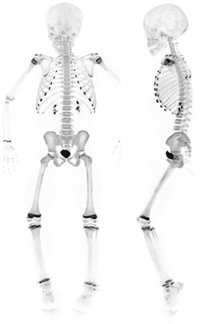 2 P E T scans of the whole human body to detect tracer uptake. The concentration in tracers is more on the epiphyseal plates of the limbs and anterior ends of the ribs.