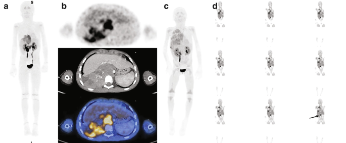 Set of 4 images for M I P in part A, trans axial P E T, C T, and P E T-C T slices in part B, M I P in part D, and coronal P E T slices in part D. Findings reveal significant tumor progression in a 5-year-old boy.