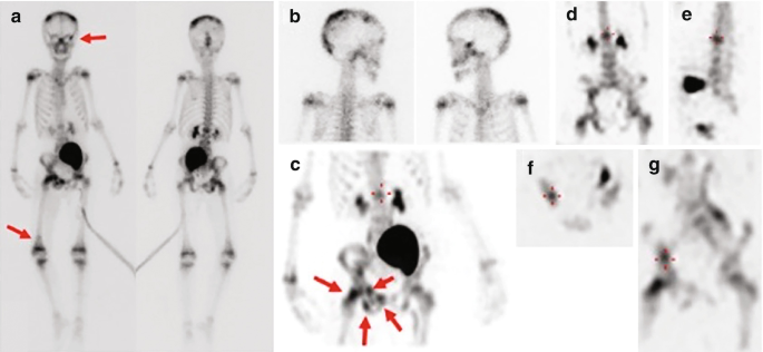 7 scanned images of an 8-year-old boy. A, anterior and posterior views of the whole body where the skull and left femur are marked with an arrow. B, lateral spot views of the skull. C, M I P image of pelvic and lumbar regions where lesions are indicated by arrows. D to G is coronal, sagittal, trans-axial, and coronal slices.