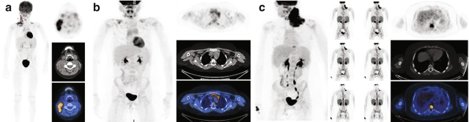 3 scans for a 7-year-old boy with Hodgkin lymphoma. A, initial scan with nodal involvement. B, post-treatment, no active H L. C, reevaluation reveals recurrence in left cervical and skeletal regions.