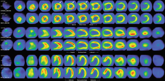 A set of scans for detecting the myocardial perfusion in the stress and rest state. The scans represent the short axis, vertical, and horizontal axis.