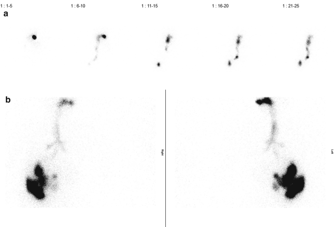 2 panels of tracheobronchial aspiration images. A, 5 posterior image views present the trachea and stomach with tracer activity. B, 2 planar images display the bilateral bronchi with tracer activity.