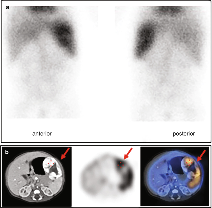 2 images exhibit a large liver hemangioma detected in the anterior and posterior views in part A. R B C scan and S P E C T-C T reveal high blood pool activity, confirming the diagnosis & spleen displacement in part b.