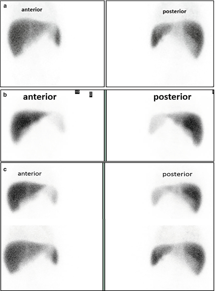 3 scans of liver and spleen. A, anterior and posterior views exhibit uniform and intense uptake. B, anterior and posterior views exhibit lower intensity. C, 2 anterior and 2 posterior views exhibit reduced spleen uptake.