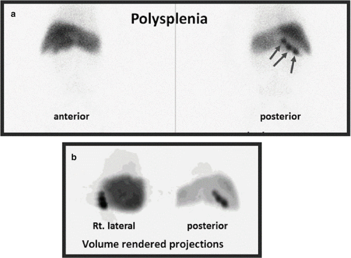 2 images. A, for polysplenia in the anterior and posterior views reveal the distribution and arrangement of small spleens indicated by arrows in the posterior view. B, volume rendered projection for the right lateral and posterior view reveal the spleens.