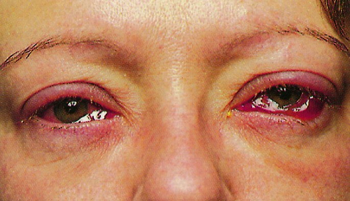Rote Augen – wann droht Gefahr? | SpringerLink