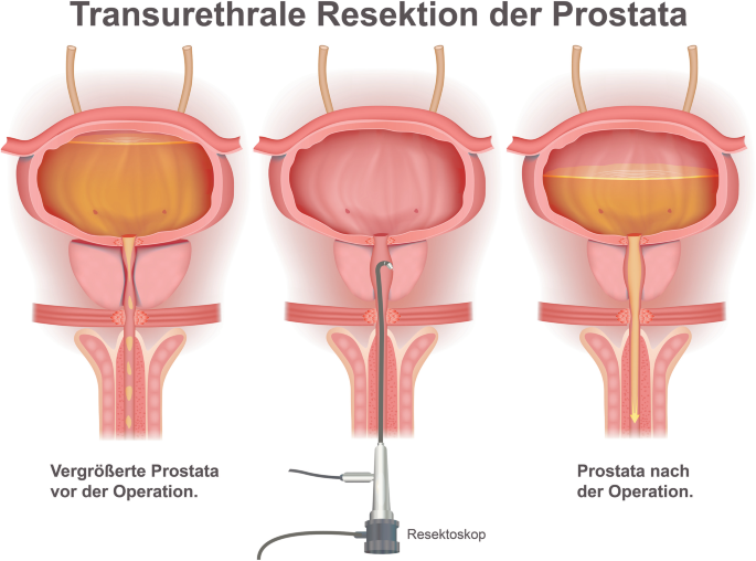Die Prostata  Einblick in ein Stck Mnnlichkeit | Springer Nature Link