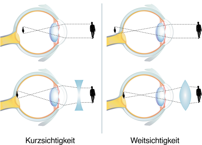 Wenn unsere Augen krank werden | Springer Nature Link