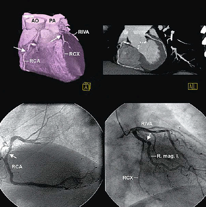 angina-pectoris-springer-nature-link