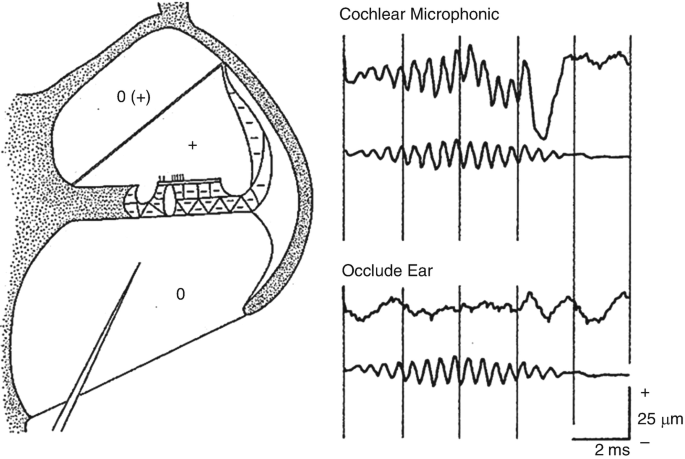 An image of a diagram of the inner ear on the left and two graphs on the right. The top-right graph illustrates the recordings of the cochlear microphone. The bottom-right graph illustrates the recordings of the occluded ear. The upper curves are irregular and variable and the lower curves are regular and constant.