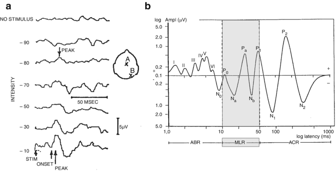 An image of seven waves on the left, irregular and variable. Circle with A and B points, on the side. Arrows in the last wave indicate the stim, onset, and peak of the curve. On the left side, is a graph with an x-axis as log latency, and a y-axis as log amplitude. The center part of the graph is highlighted. The amplitude of the curve increases gradually.