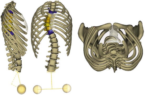 Biomechanics of Adolescent Idiopathic Scoliosis | SpringerLink