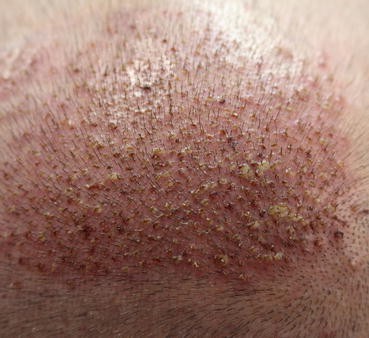 Crusting and redness due to folliculitis following a hair transplant