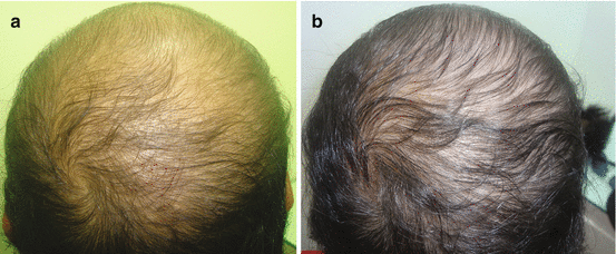 The LINK Between Micronutrient DEFICIENCY  Hair Loss  YouTube