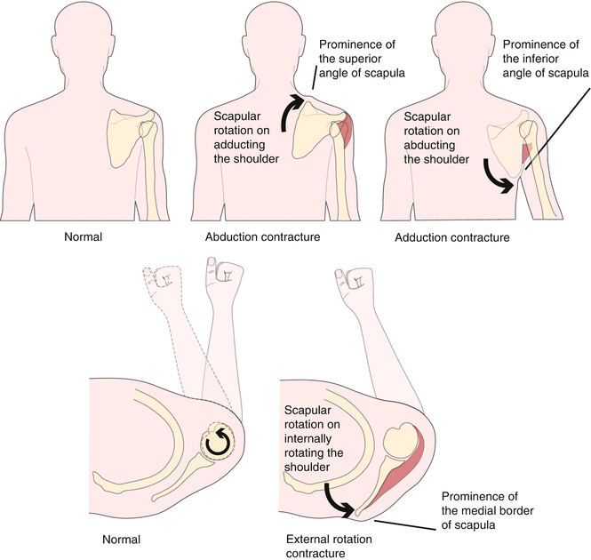 Deformities and Limitation of Movements of the Shoulder Girdle